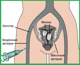 Эмболизация маточных артерий при миоме матки в нижнем новгороде цена